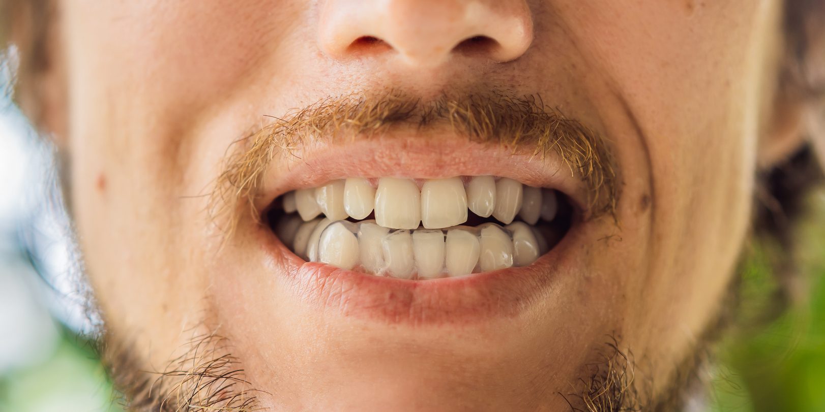 Poradnik ochrony zębów – jak zapobiegać urazom
