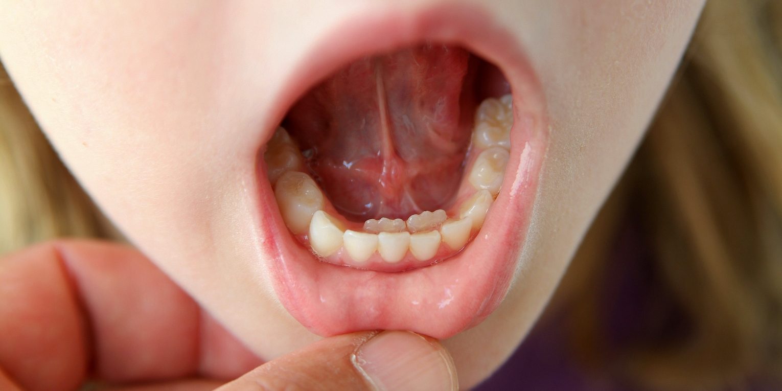 Najczęstsze problemy stomatologiczne u dzieci i jak im zapobiegać