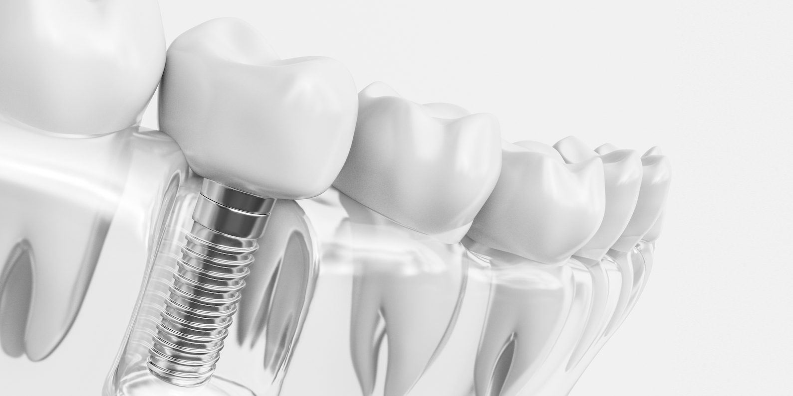 Implanty zębowe – korzyści, procedura i pielęgnacja po zabiegu